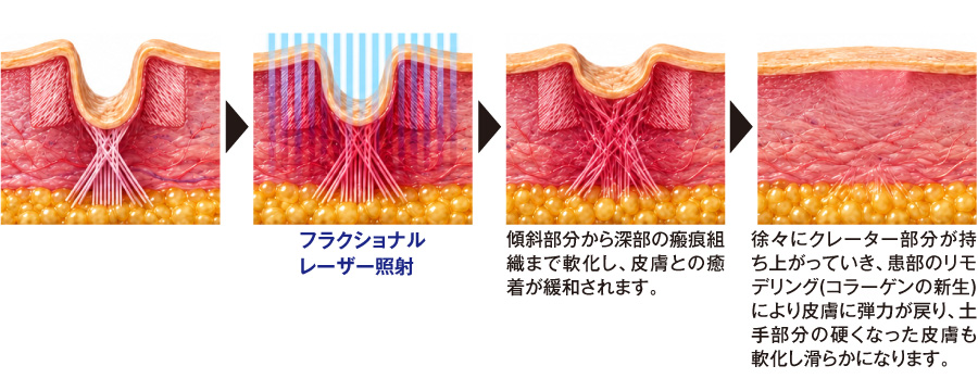 フラクショナルレーザー治療の仕組み