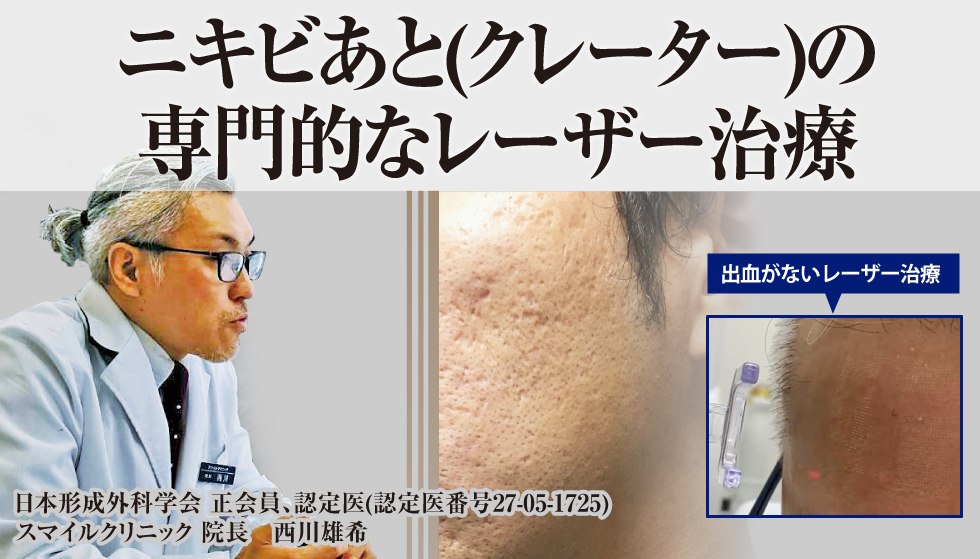 形成外科専門医によるニキビあと治療(クレーター)