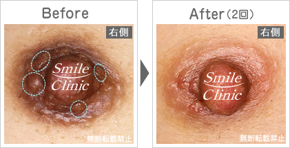 モントゴメリー腺除去