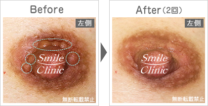 モントゴメリー腺除去