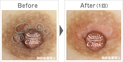 モントゴメリー腺除去