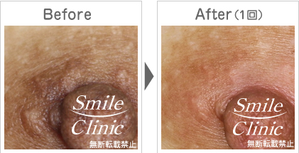 モントゴメリー腺除去