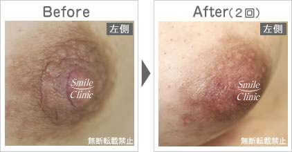 モントゴメリー腺除去