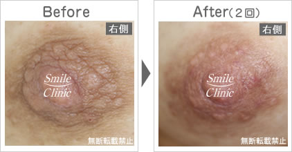 モントゴメリー腺除去