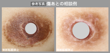 他院での治療痕