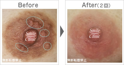 モントゴメリー腺除去