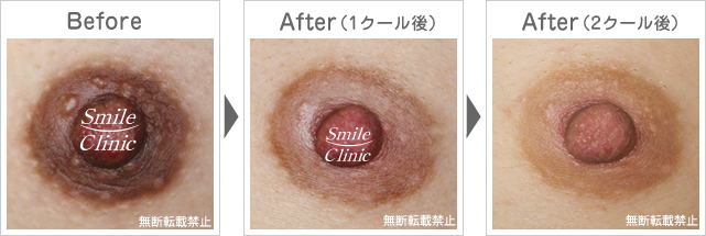 ニップル重症例 フチドリも改善