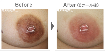 ニップル重症例 フチドリも改善