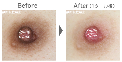 ニップル重症例 フチドリも改善