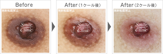 ニップル重症例 フチドリも改善