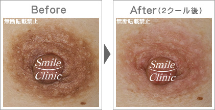 ニップル早期改善