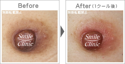 くすみからピンクへ早期改善