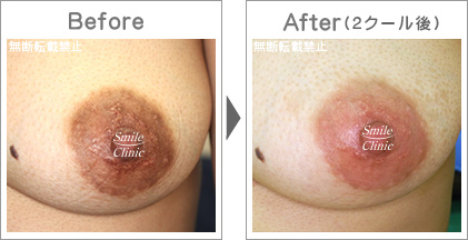 くすみからピンクへ早期改善