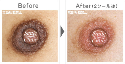 アトピー苔癬も改善