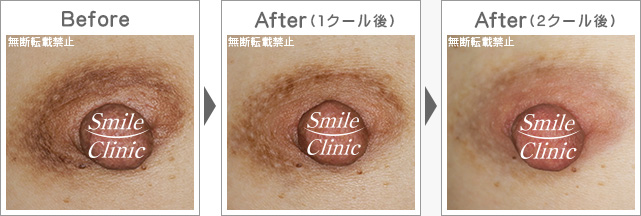 アトピー苔癬も改善