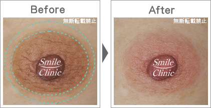 軽症例　先行治療で炎症