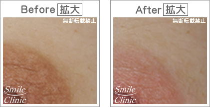 軽症例　先行治療で炎症