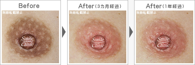 １年経過再発なし