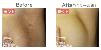 乳がん摘出後の皮膚炎、放射線治療後の皮膚炎・色素の改善before-after