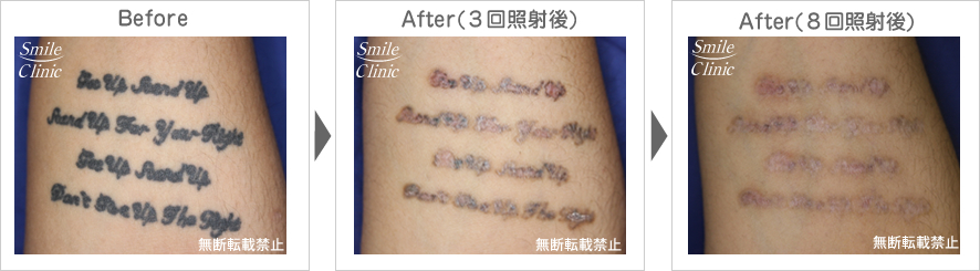 タトゥー・刺青のレーザー除去before-after