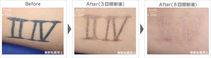 タトゥー・刺青のレーザー除去before-after