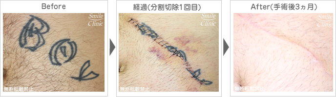 タトゥー・刺青の除去手術before-after