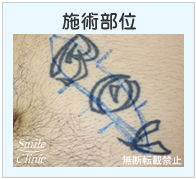 タトゥー・刺青の除去手術の施術部位