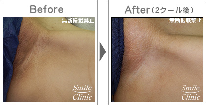 デリケートゾーン黒ずみ