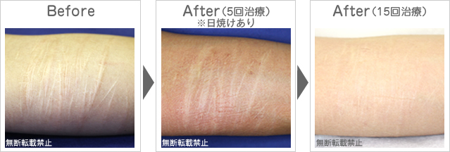 リストカット痕の除去