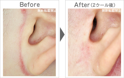 フェイスリフトの傷あと除去