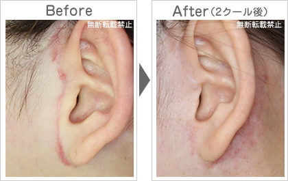フェイスリフトの傷あと除去