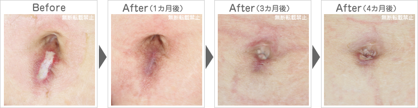 おヘソの手術痕の除去