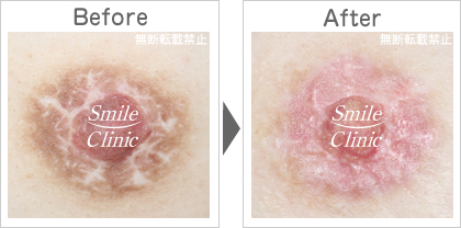 傷跡の除去before-after