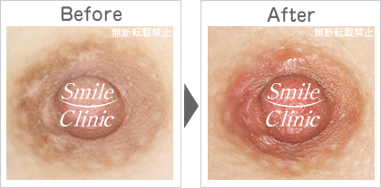傷跡の除去before-after