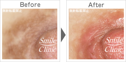 傷跡の除去before-after