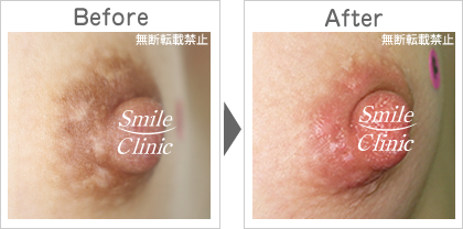 傷跡の除去before-after