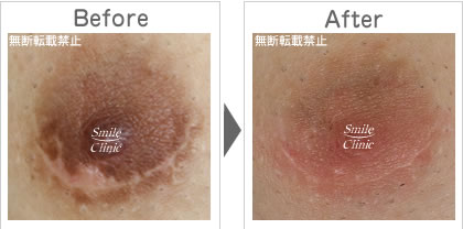 傷跡の除去before-after
