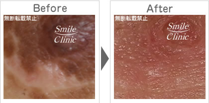 傷跡の除去before-after