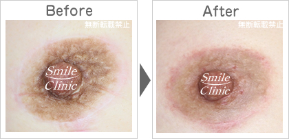傷跡の除去before-after
