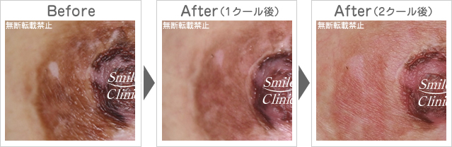乳輪乳頭の傷あとの除去