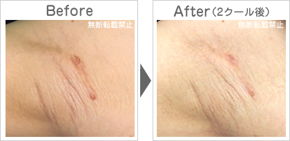 ワキの傷あとの除去