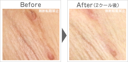 ワキの傷あとの除去