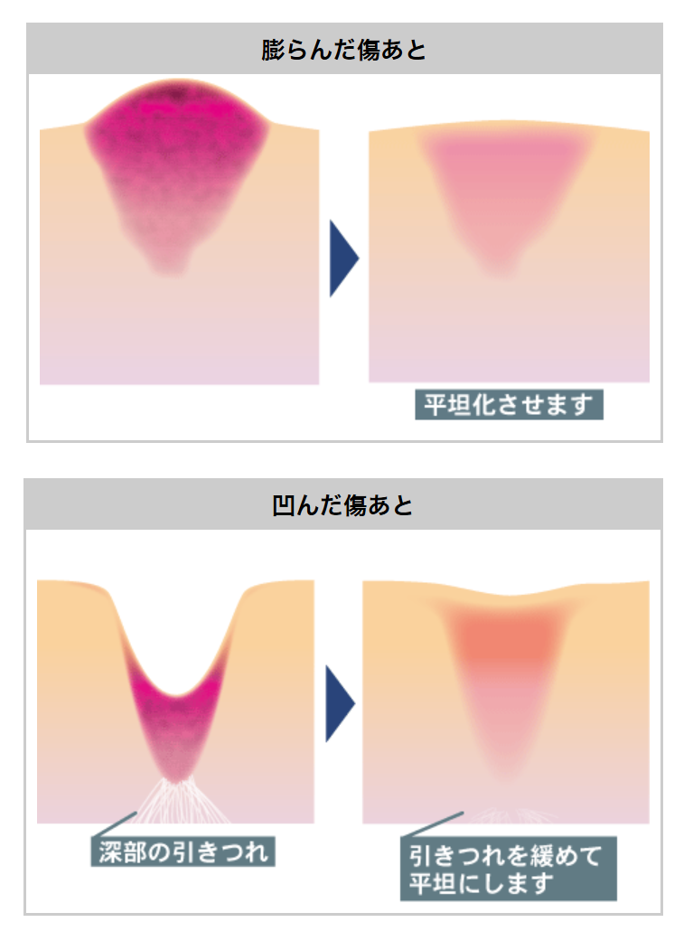 スマイルクリニック｜新宿・銀座 診療案内｜痕｜手術あとなどの治療 - スマイルクリニック｜新宿・銀座