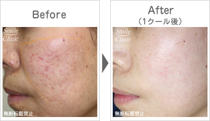 フラクショナルレーザー治療の症例1